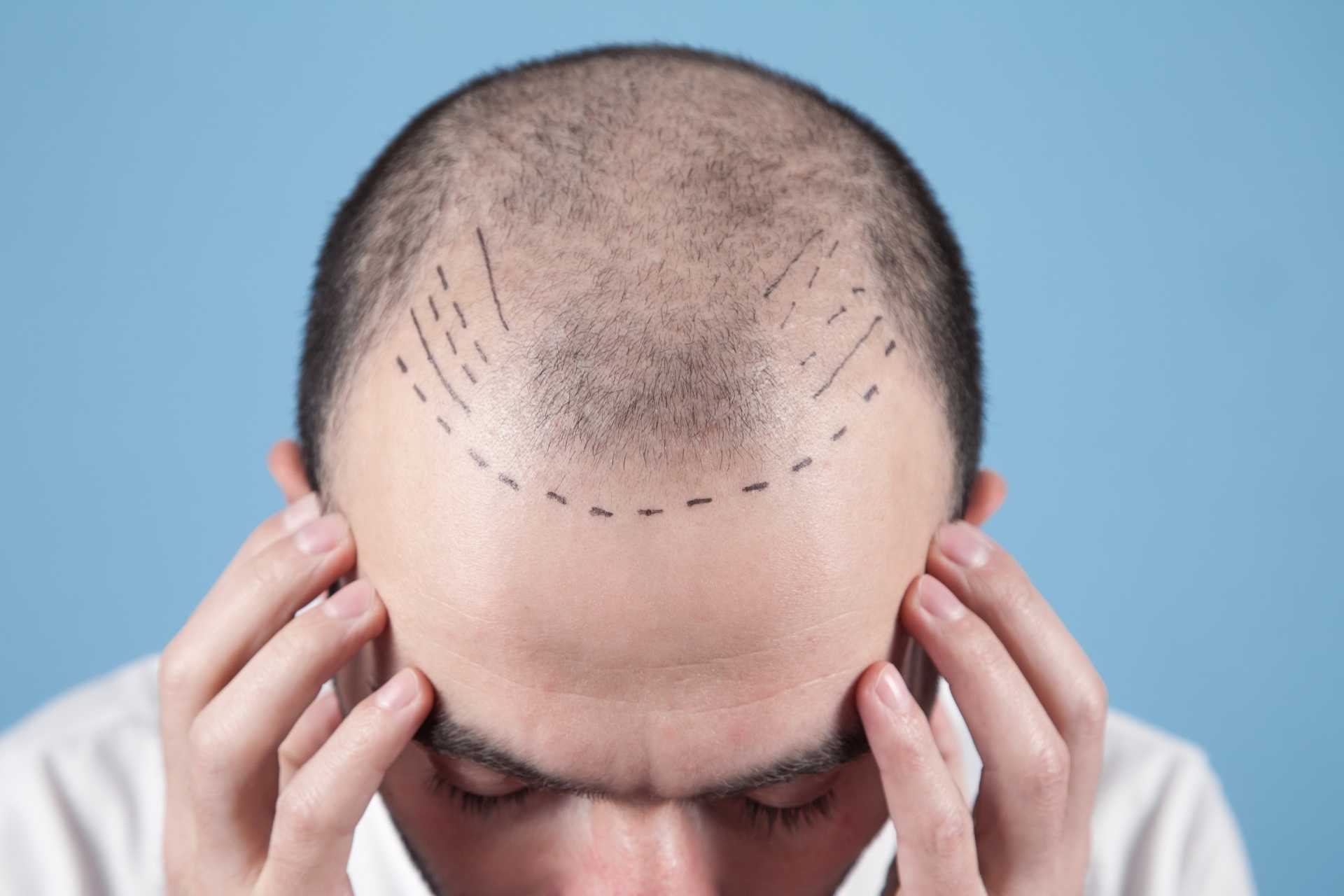 Greffe de cheveux : combien de temps avant de voir les résultats définitifs ?